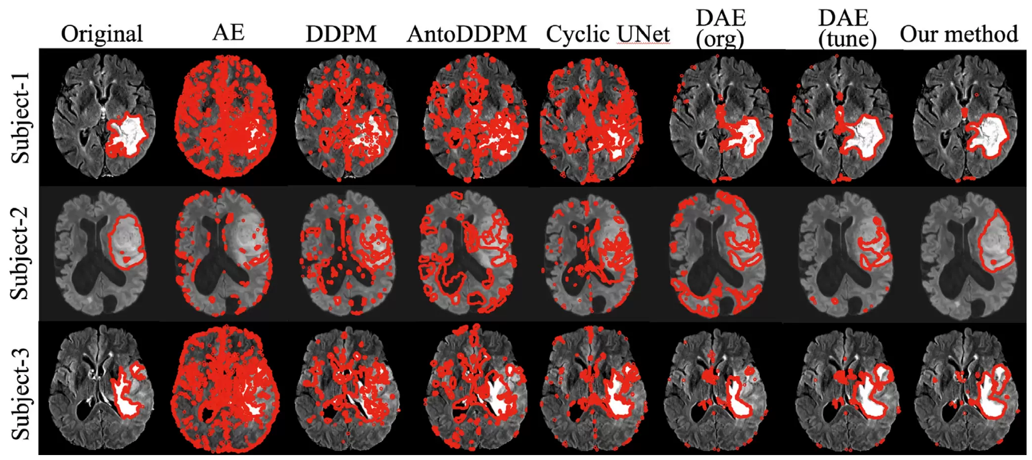 Figure 2: Anomaly segmentation results on 3D FLAIR inputs from BraTS using IterMask3D. Red contours indicate the boundaries of the predicted segmentation masks overlaid on the original images.